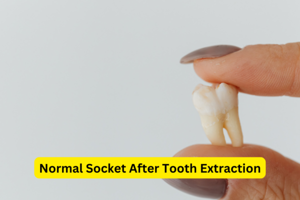 Normal Socket After Tooth Extraction