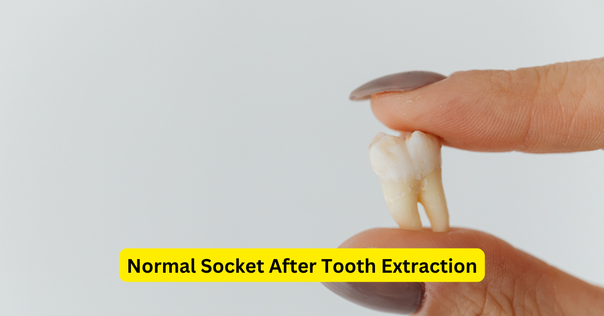 Normal Socket After Tooth Extraction